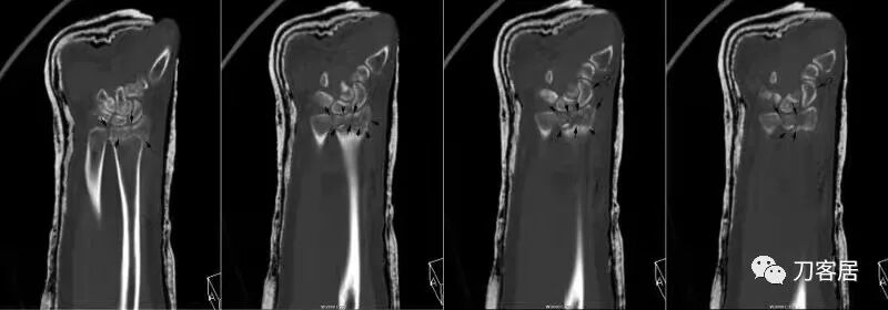 聚酯石膏怎么打6岁孩子的尺桡骨双骨折，就给手术了？外固定架外面还打石膏？_https://www.jmylbn.com_新闻资讯_第51张