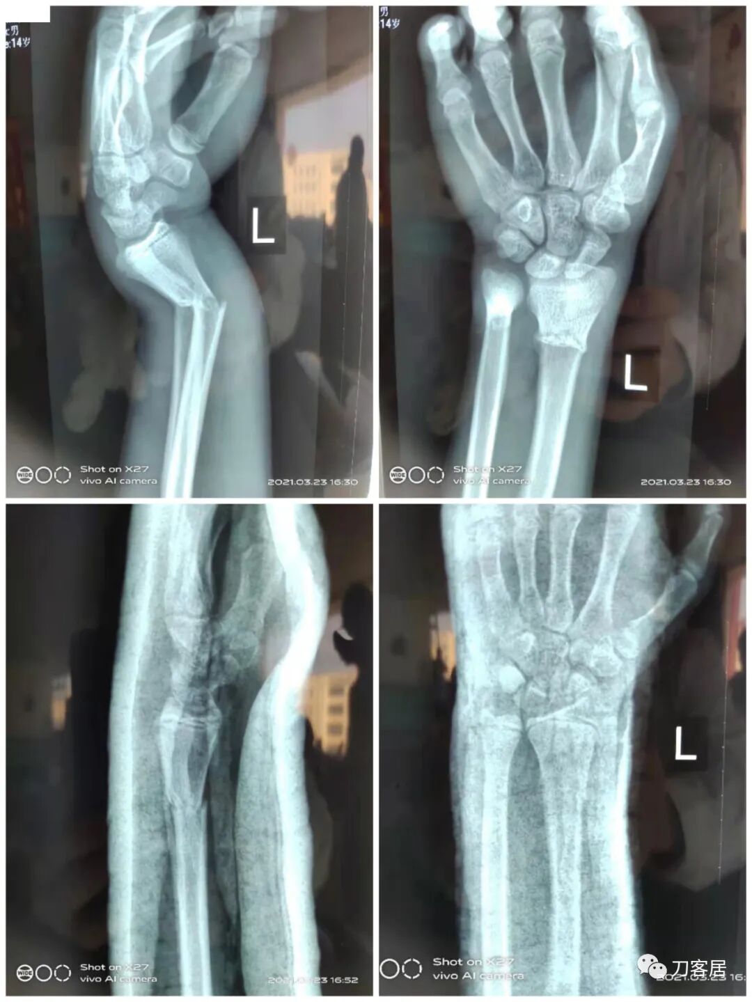 聚酯石膏怎么打6岁孩子的尺桡骨双骨折，就给手术了？外固定架外面还打石膏？_https://www.jmylbn.com_新闻资讯_第44张