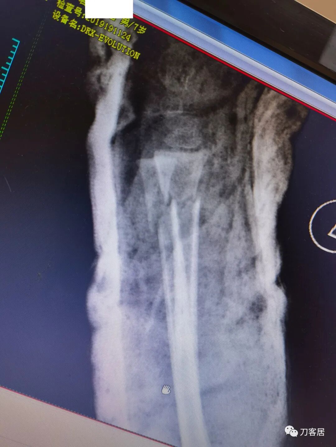 聚酯石膏怎么打6岁孩子的尺桡骨双骨折，就给手术了？外固定架外面还打石膏？_https://www.jmylbn.com_新闻资讯_第59张