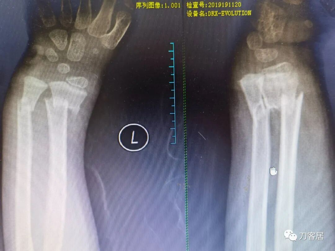 聚酯石膏怎么打6岁孩子的尺桡骨双骨折，就给手术了？外固定架外面还打石膏？_https://www.jmylbn.com_新闻资讯_第58张