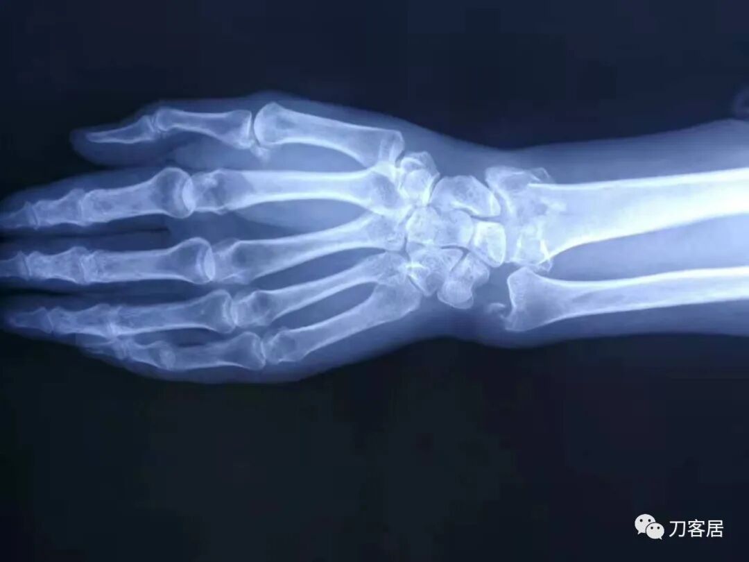 聚酯石膏怎么打6岁孩子的尺桡骨双骨折，就给手术了？外固定架外面还打石膏？_https://www.jmylbn.com_新闻资讯_第54张