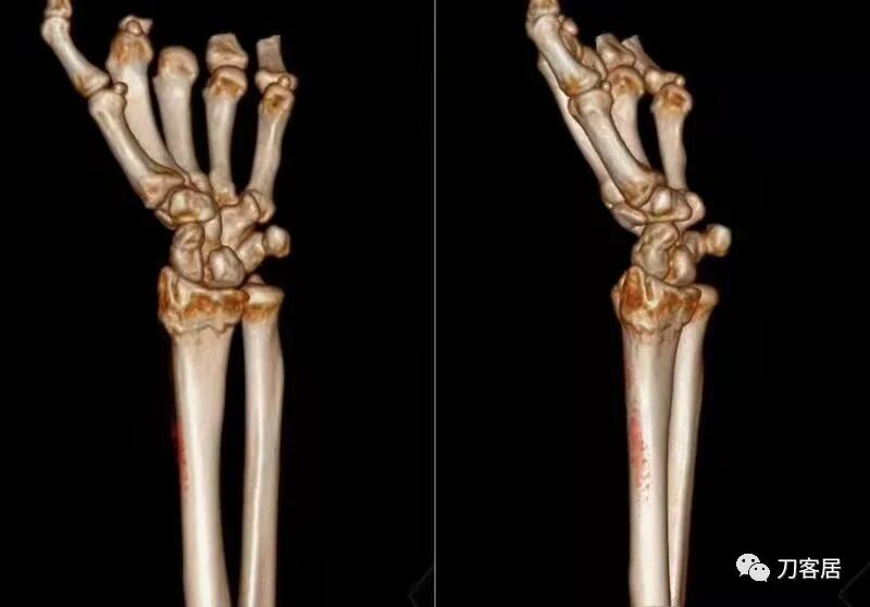 聚酯石膏怎么打6岁孩子的尺桡骨双骨折，就给手术了？外固定架外面还打石膏？_https://www.jmylbn.com_新闻资讯_第53张