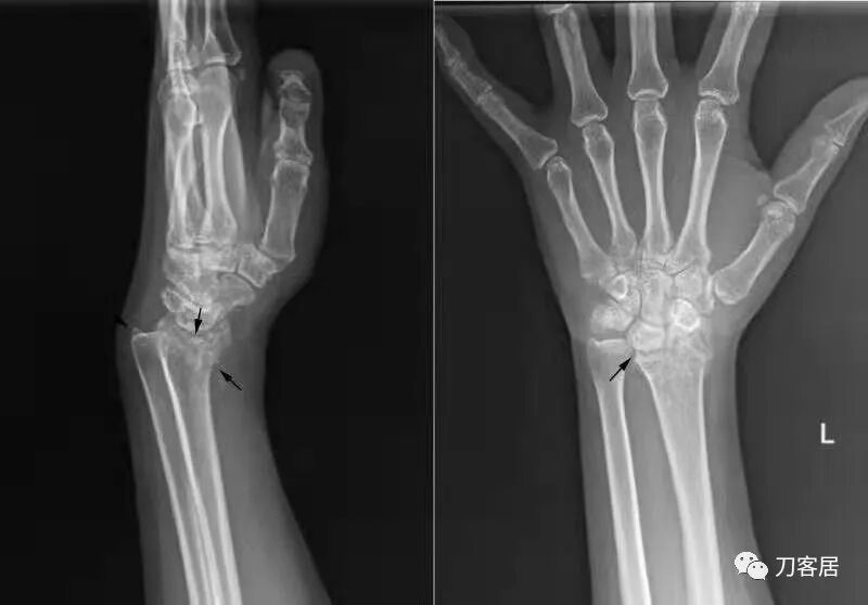 聚酯石膏怎么打6岁孩子的尺桡骨双骨折，就给手术了？外固定架外面还打石膏？_https://www.jmylbn.com_新闻资讯_第49张