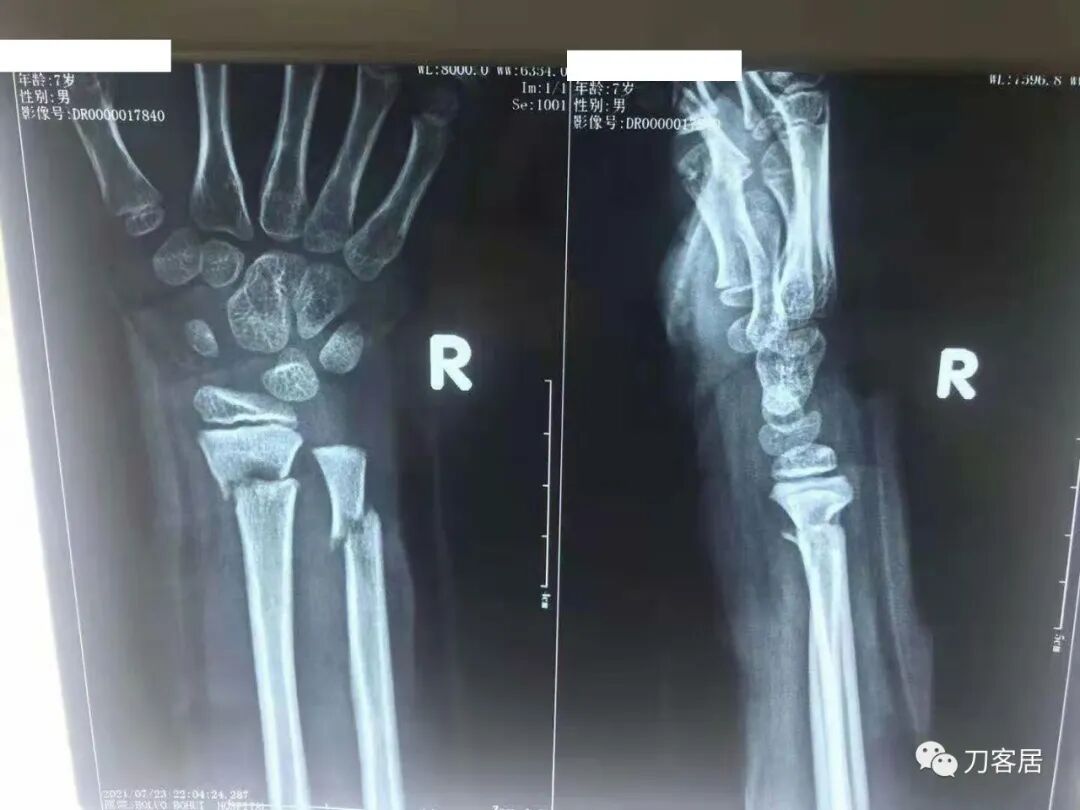 聚酯石膏怎么打6岁孩子的尺桡骨双骨折，就给手术了？外固定架外面还打石膏？_https://www.jmylbn.com_新闻资讯_第30张