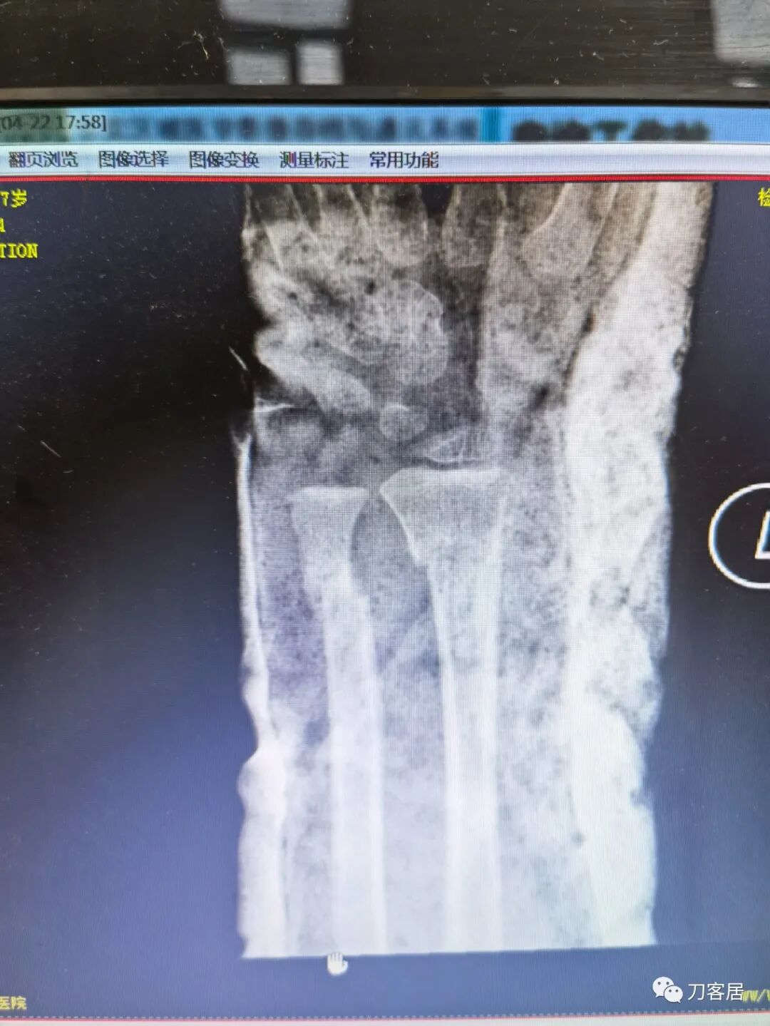 聚酯石膏怎么打6岁孩子的尺桡骨双骨折，就给手术了？外固定架外面还打石膏？_https://www.jmylbn.com_新闻资讯_第60张