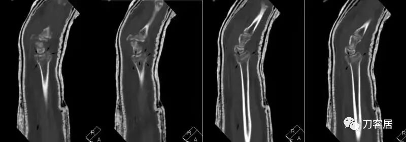 聚酯石膏怎么打6岁孩子的尺桡骨双骨折，就给手术了？外固定架外面还打石膏？_https://www.jmylbn.com_新闻资讯_第52张