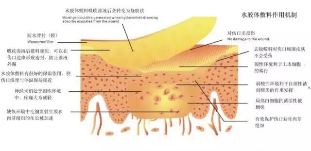 水胶体创口怎么去除创可贴的未来趋势？这个可吸收伤口污染物、促进愈合的敷料你用过吗_https://www.jmylbn.com_新闻资讯_第10张