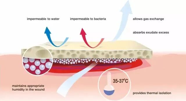 水胶体创口怎么去除创可贴的未来趋势？这个可吸收伤口污染物、促进愈合的敷料你用过吗_https://www.jmylbn.com_新闻资讯_第9张