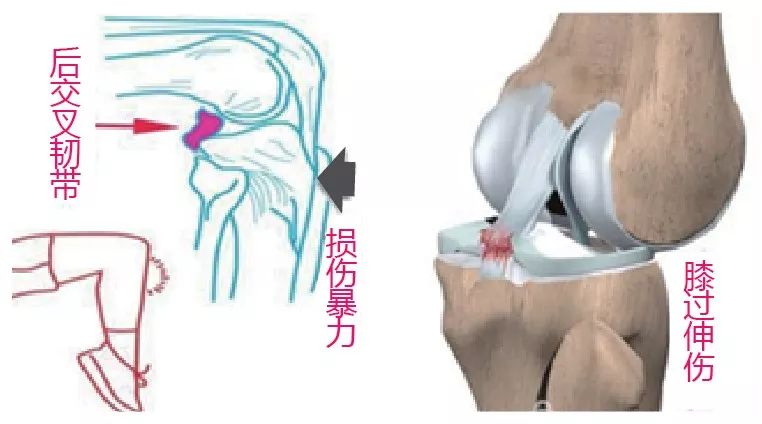 胫骨镶嵌技术让膝关节韧带 重获新生 辽宁省人民医院订阅号 微信公众号文章阅读 Wemp