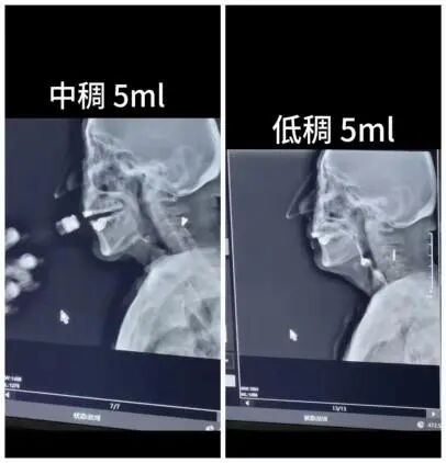 什么是鼻胃管告别“大象鼻”——IOE间歇口胃管吞咽患者的福音_https://www.jmylbn.com_新闻资讯_第5张