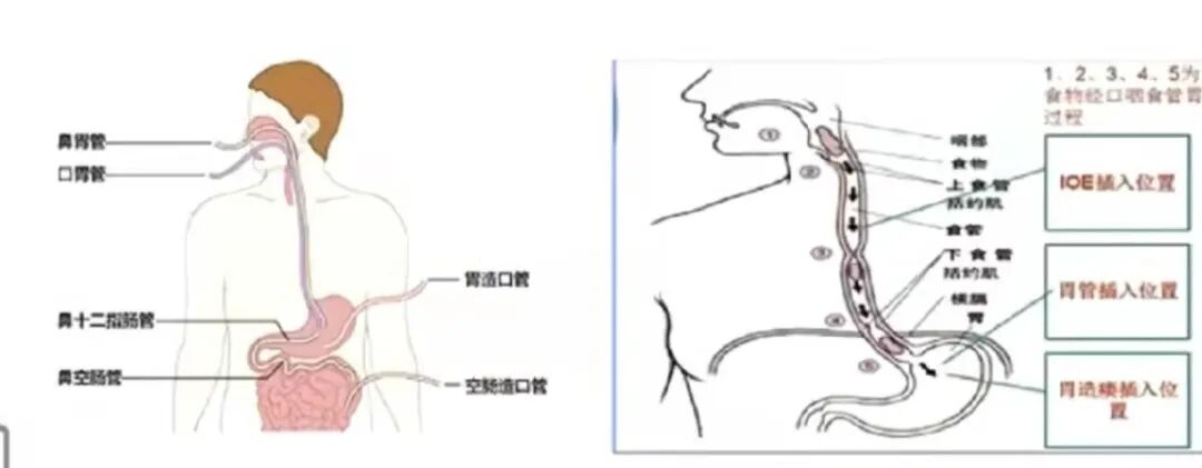 什么是鼻胃管告别“大象鼻”——IOE间歇口胃管吞咽患者的福音_https://www.jmylbn.com_新闻资讯_第3张