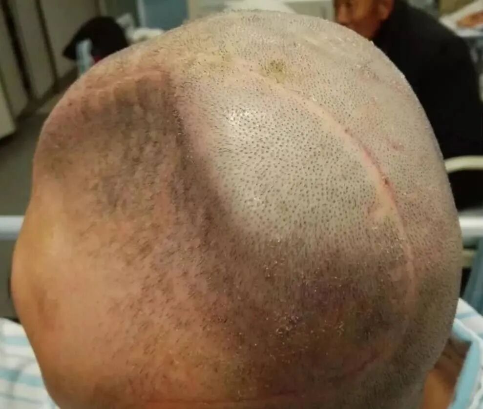 三维钛网是什么颅骨缺损需要手术吗？三维数字塑形钛网显神通_https://www.jmylbn.com_新闻资讯_第6张