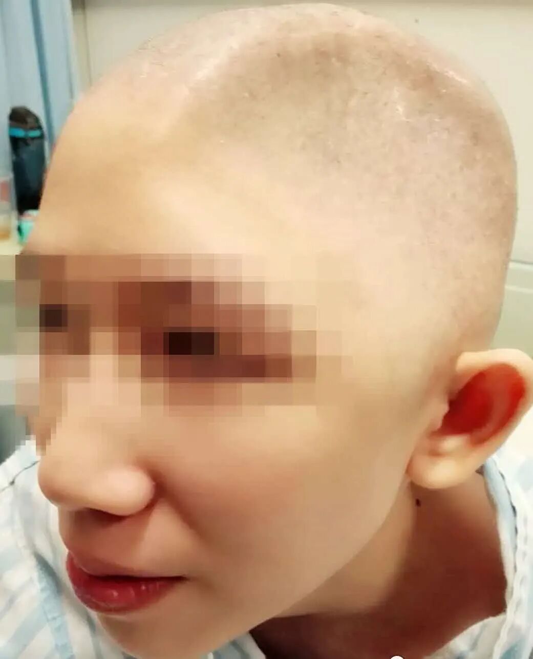 三维钛网是什么颅骨缺损需要手术吗？三维数字塑形钛网显神通_https://www.jmylbn.com_新闻资讯_第4张