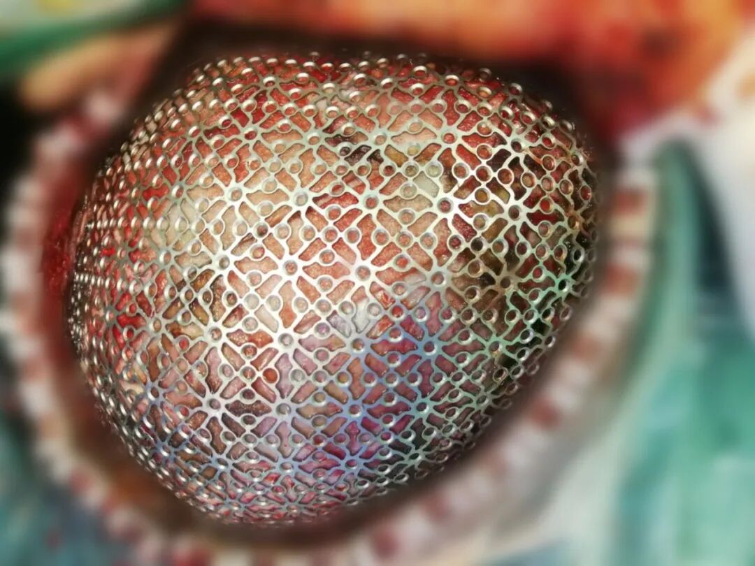 三维钛网是什么颅骨缺损需要手术吗？三维数字塑形钛网显神通_https://www.jmylbn.com_新闻资讯_第8张