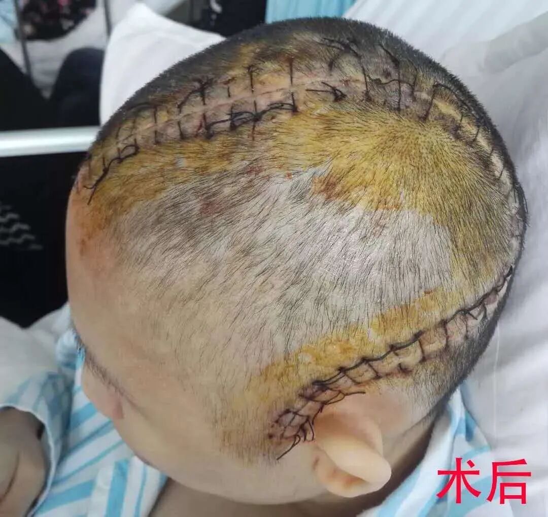 三维钛网是什么颅骨缺损需要手术吗？三维数字塑形钛网显神通_https://www.jmylbn.com_新闻资讯_第7张