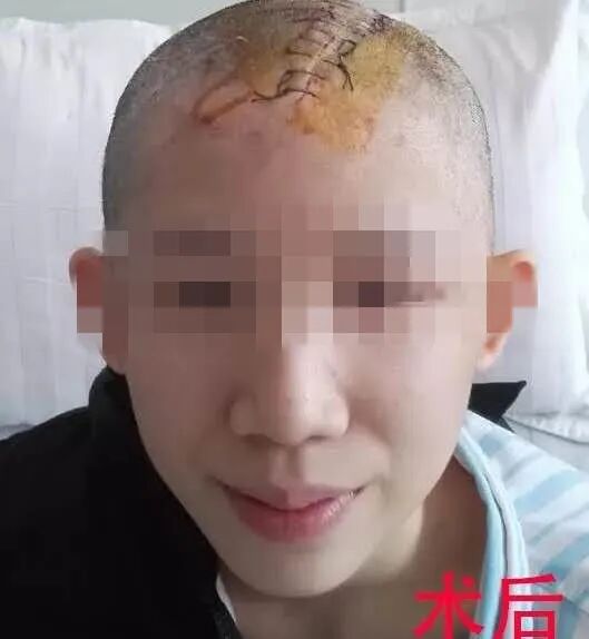 三维钛网是什么颅骨缺损需要手术吗？三维数字塑形钛网显神通_https://www.jmylbn.com_新闻资讯_第5张