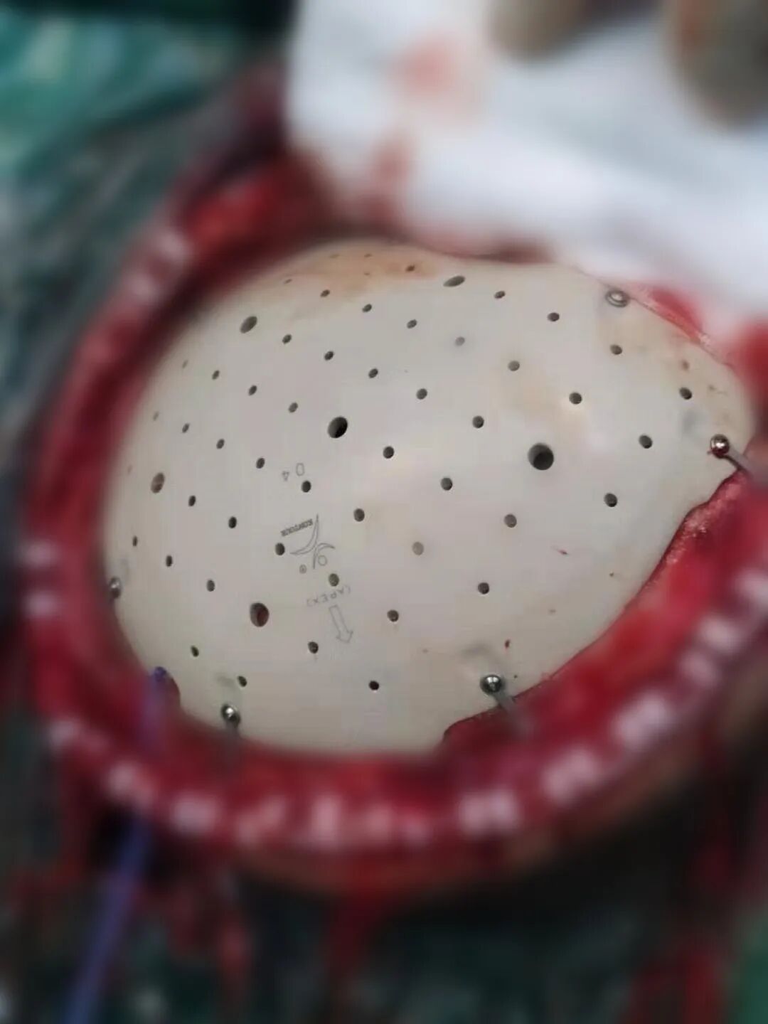 三维钛网是什么颅骨缺损需要手术吗？三维数字塑形钛网显神通_https://www.jmylbn.com_新闻资讯_第10张