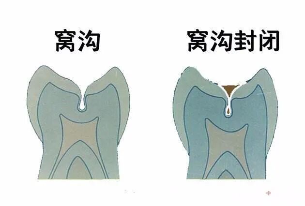 为什么宝宝做了窝沟封闭还会蛀牙？