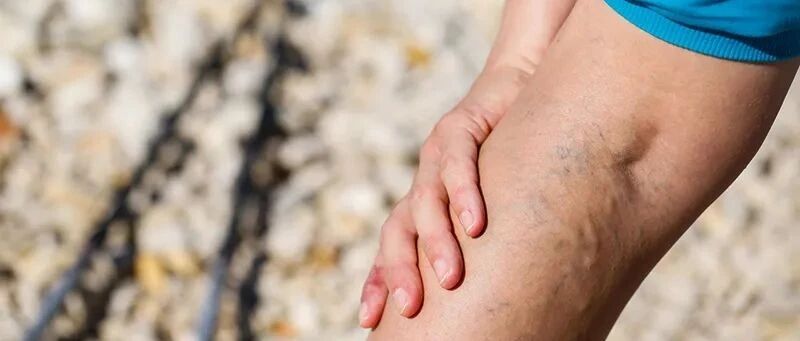 “青筋”暴起，说明有毒素淤积?尤其这几个地方，一定要注意!