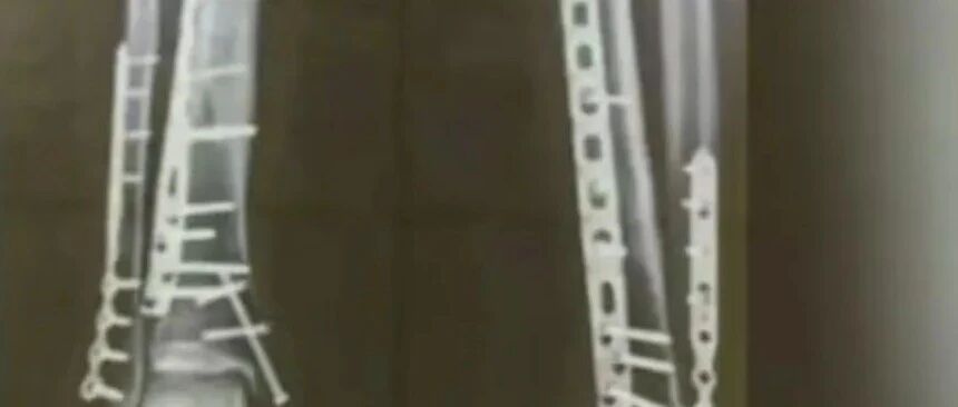 这张X光片刷屏！网友：破大防了......