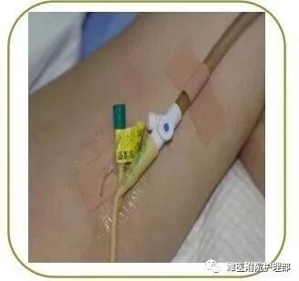 怎么固定引流管八种引流管固定方法，固定得结实又漂亮！_https://www.jmylbn.com_新闻资讯_第31张