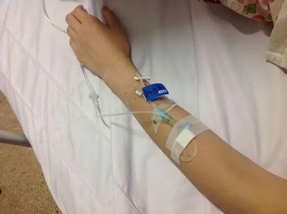 怎么固定引流管八种引流管固定方法，固定得结实又漂亮！_https://www.jmylbn.com_新闻资讯_第2张