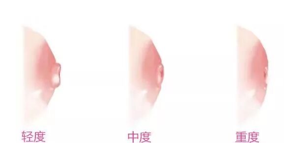 乳头凹陷难哺乳？试试这几个矫正方法！