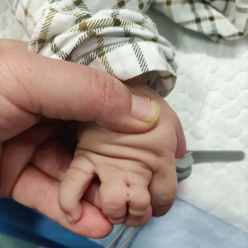 为什么手术要这么多剪刀双手并指畸形！6个月男孩成功摆脱“剪刀手”——我院整形科成功完成并指分离手术_https://www.jmylbn.com_新闻资讯_第2张