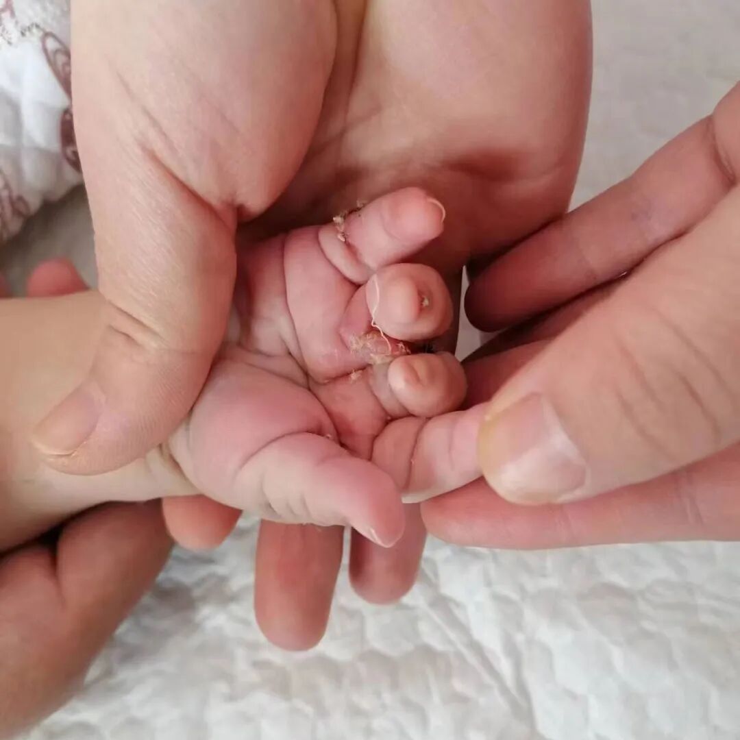 为什么手术要这么多剪刀双手并指畸形！6个月男孩成功摆脱“剪刀手”——我院整形科成功完成并指分离手术_https://www.jmylbn.com_新闻资讯_第4张