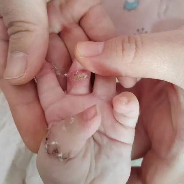 为什么手术要这么多剪刀双手并指畸形！6个月男孩成功摆脱“剪刀手”——我院整形科成功完成并指分离手术_https://www.jmylbn.com_新闻资讯_第5张