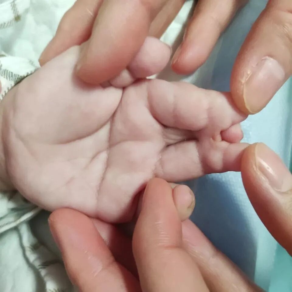 为什么手术要这么多剪刀双手并指畸形！6个月男孩成功摆脱“剪刀手”——我院整形科成功完成并指分离手术_https://www.jmylbn.com_新闻资讯_第1张