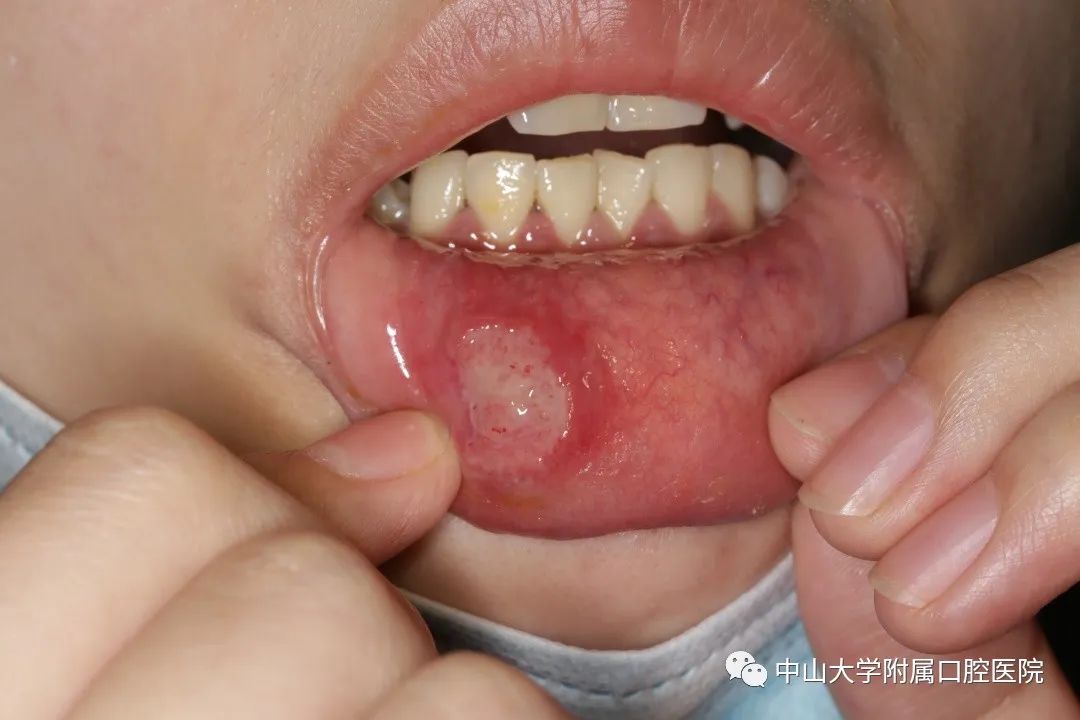 口腔溃疡，你了解吗