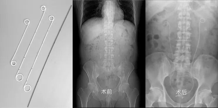 猪尾巴导管怎么拔出泌尿外科的利器——『猪尾巴导管』(双J管)_https://www.jmylbn.com_新闻资讯_第4张