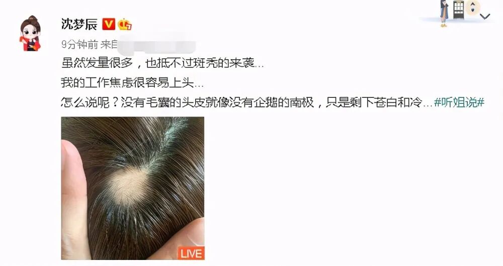 沈梦辰自曝斑秃上热搜，网友：太有共鸣了……