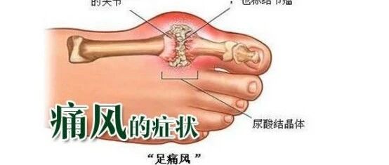 痛风病友需要终身服药吗？