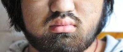 多毛症，脱毛就解决了吗？