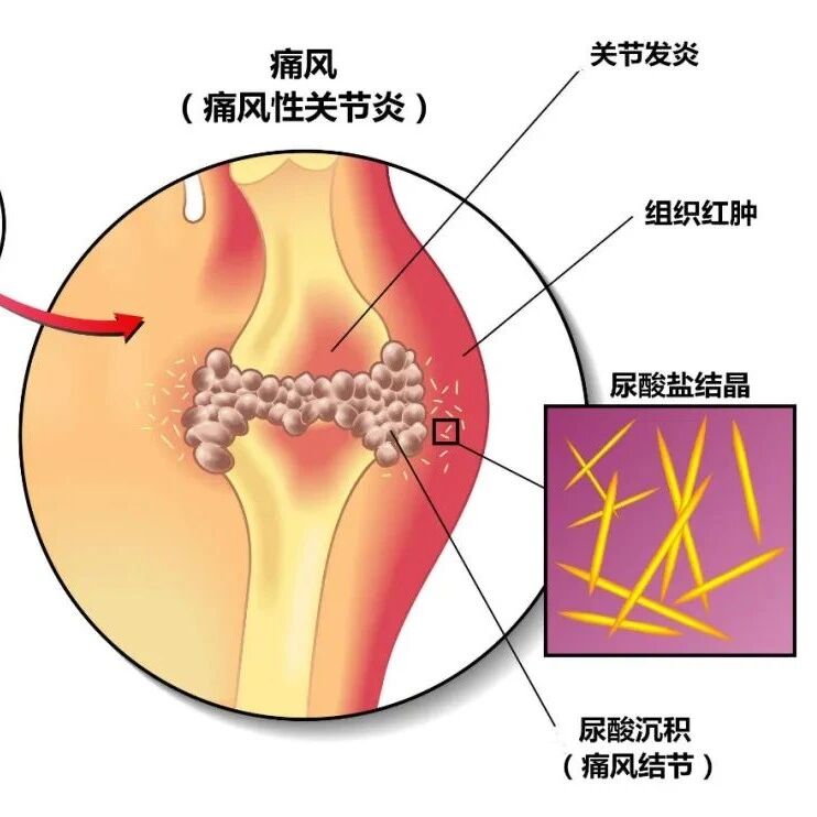 痛风用药最全攻略 100％干货