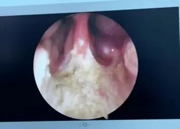 耳匙是什么不同手术方式切除腺样体，有什么区别？_https://www.jmylbn.com_新闻资讯_第14张