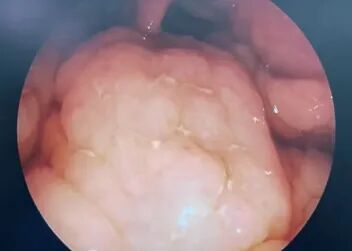 耳匙是什么不同手术方式切除腺样体，有什么区别？_https://www.jmylbn.com_新闻资讯_第12张