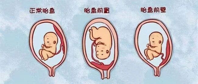 前壁胎盘、前置胎盘，一字之差，一个安全，一个“险”