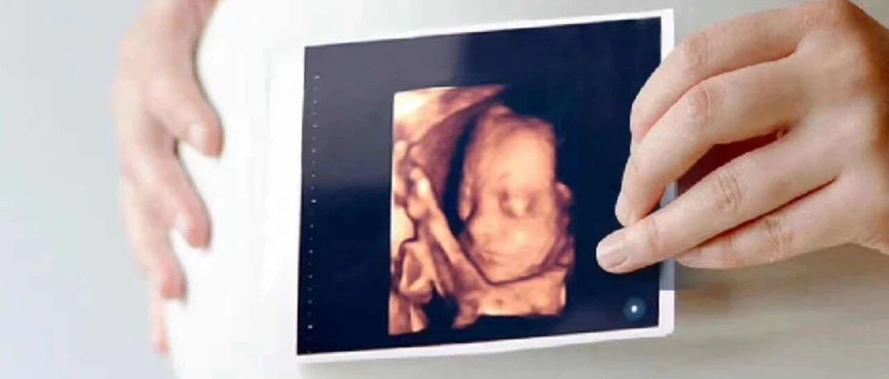 产检要明明白白的做！四维彩超，全面筛查排畸