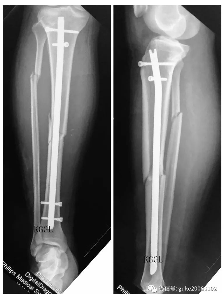 两例胫腓骨骨折治疗的选择 刻骨甘露 微信公众号文章阅读 Wemp
