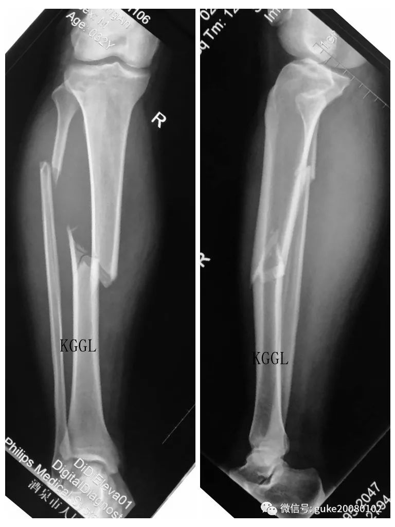 两例胫腓骨骨折治疗的选择 刻骨甘露 微信公众号文章阅读 Wemp