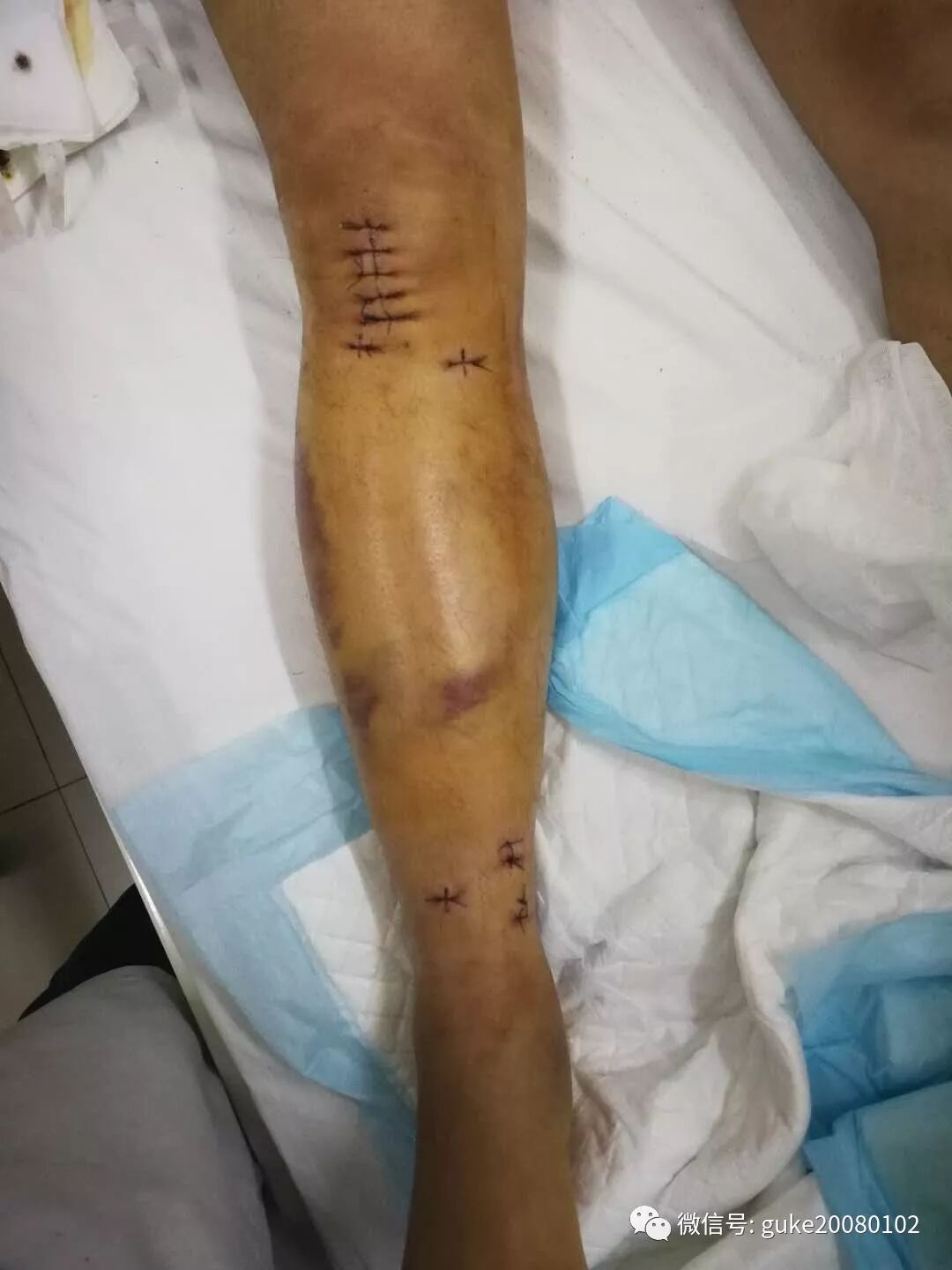两例胫腓骨骨折治疗的选择 刻骨甘露 微信公众号文章阅读 Wemp