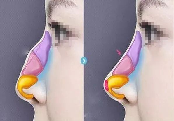 什么是骨锉“驼峰鼻”长什么样？_https://www.jmylbn.com_新闻资讯_第4张