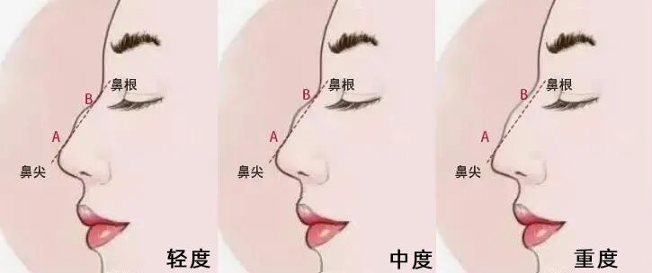 什么是骨锉“驼峰鼻”长什么样？_https://www.jmylbn.com_新闻资讯_第6张