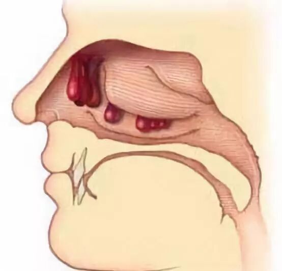 鼻息肉的危害那么多，那会癌变吗？该怎么预防呢？