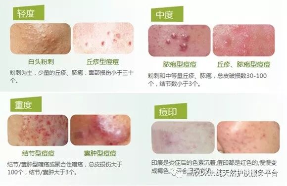 脓包型痤疮是什么 长了脓包型痤疮怎么护理 董欣dxin纯天然护肤服务平台 微信公众号文章阅读 Wemp