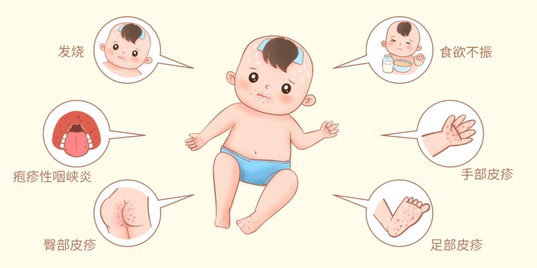 5月健康提示丨注意预防新冠诺如病毒手足口病