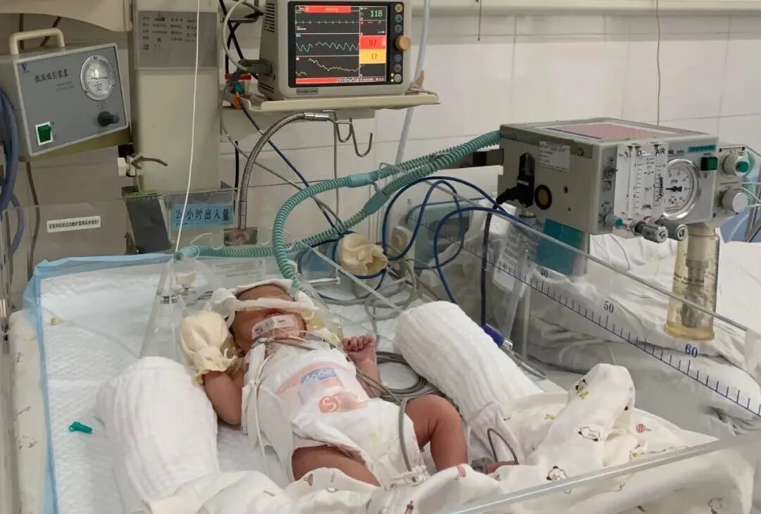 儿科CPAP为什么镇静【医疗技术】龙湖区医共体集团总院儿科应用鼻塞式CPAP治疗早期新生儿肺透明膜病_https://www.jmylbn.com_新闻资讯_第6张